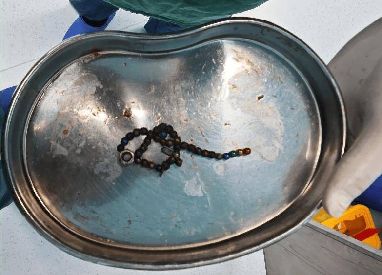 整整37颗！云南4岁孩子身体里取出……医生紧急提醒！