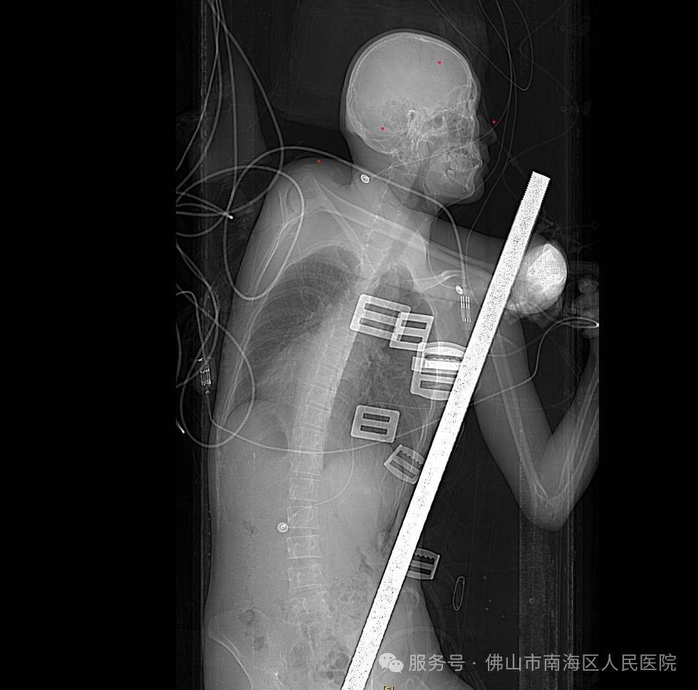 佛山一男子意外从高空坠落，1.5米长钢筋从肛门贯穿胸腔......